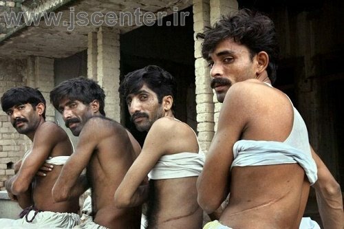 پیوند کلیه قاچاق